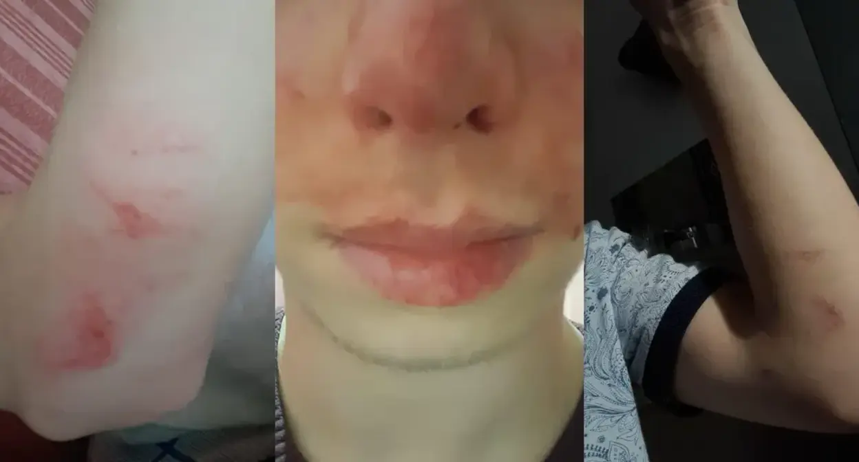 Следы от побоев на теле пропавшего подростка. Фото: "СК SOS"