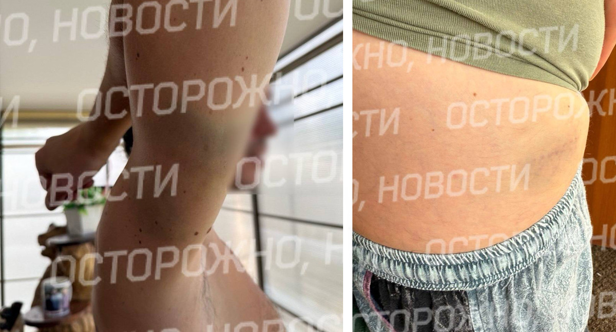 Следы пыток. Источник: https://t.me/ostorozhno_novosti/40318